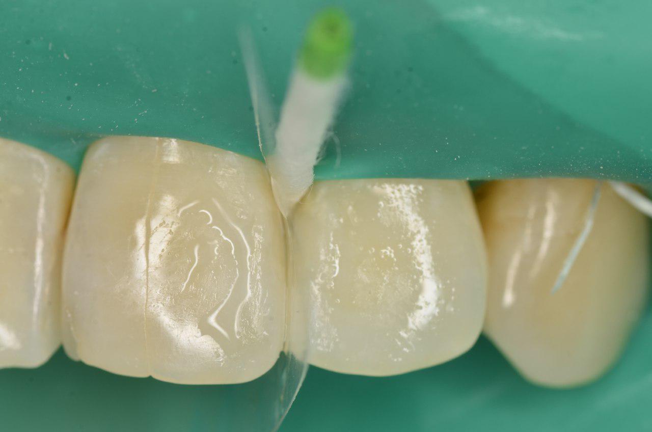 В процессе лечения. Создание правильной формы боковой поверхности зуба