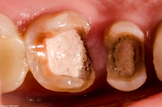 Ситуация до лечения Значительное разрушение двух жевательных зубов