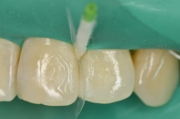 В процессе лечения. Создание правильной формы боковой поверхности зуба